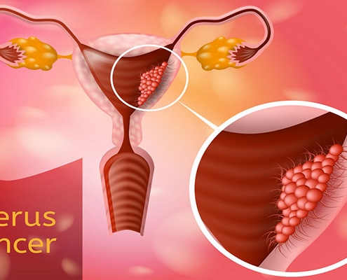علائم سرطان رحم