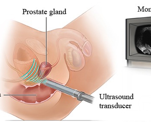 سونوگرافی واژینال